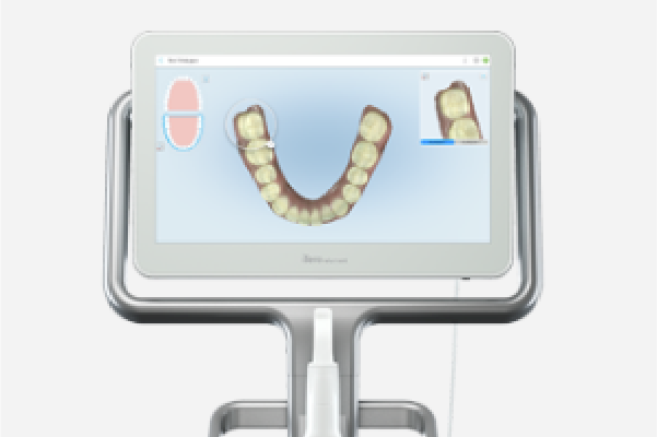 デジタルデータによる精密治療を実現した口腔内スキャナー「iTero」